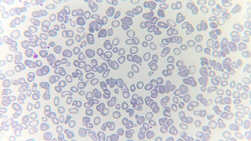 Alpha thalassemia